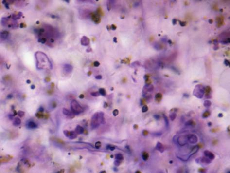 Mucor Infection