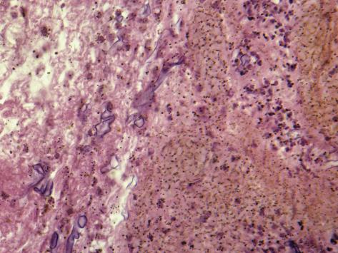 Mucor Infection