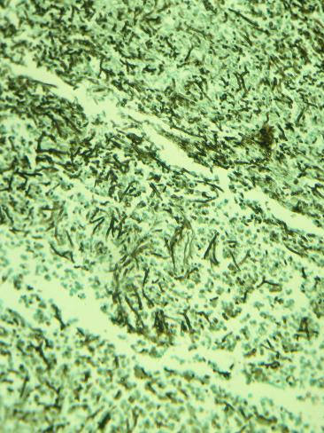 Mucor Infection