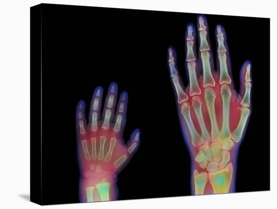 Adult And Child Hand X-rays-Science Photo Library-Premier Image Canvas