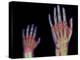 Adult And Child Hand X-rays-Science Photo Library-Premier Image Canvas