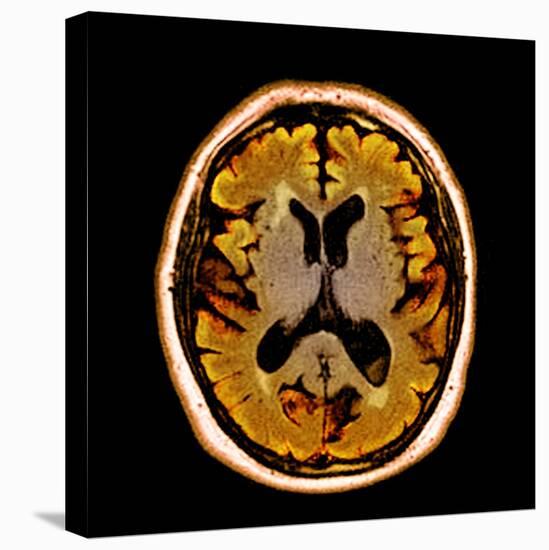 Alcoholic Dementia, MRI Scan-Du Cane Medical-Premier Image Canvas
