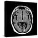 Alcoholic Dementia, MRI Scan-Du Cane Medical-Premier Image Canvas