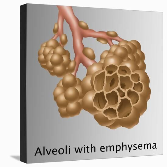 Alveoli with Emphysema-Gwen Shockey-Premier Image Canvas