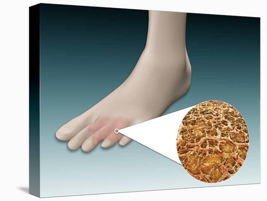 Anatomy of Foot Fungus with Microscopic Close-Up-null-Stretched Canvas