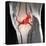 Anterior Cruciate Ligament Tear, CT Scan-Du Cane Medical-Premier Image Canvas