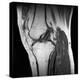 Anterior Cruciate Ligament Tear, CT Scan-Du Cane Medical-Premier Image Canvas