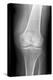 Arthritic Knee, X-ray-Du Cane Medical-Premier Image Canvas