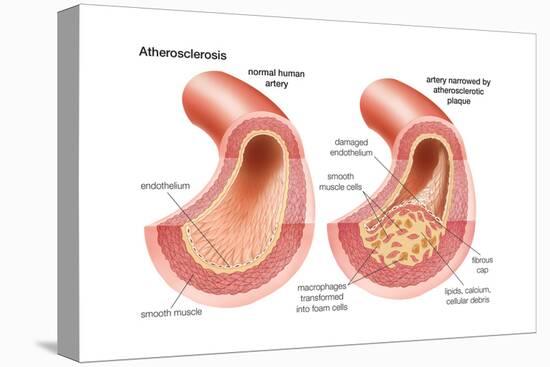 Atherosclerosis-Encyclopaedia Britannica-Stretched Canvas