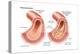 Atherosclerosis-Encyclopaedia Britannica-Stretched Canvas