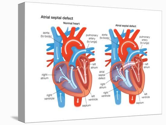 Atrial Septal Defect-Encyclopaedia Britannica-Stretched Canvas