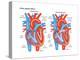 Atrial Septal Defect-Encyclopaedia Britannica-Stretched Canvas