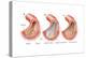 Balloon Angioplasty and Stent Insertion. Cardiovascular System, Health and Disease-Encyclopaedia Britannica-Stretched Canvas