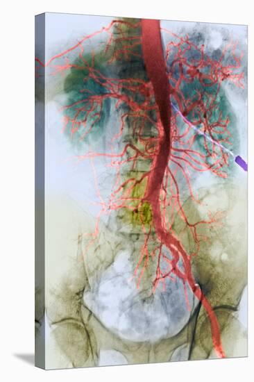 Blocked Artery, X-ray-null-Premier Image Canvas