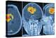 Brain Tumour, MRI Scan-PASIEKA-Premier Image Canvas