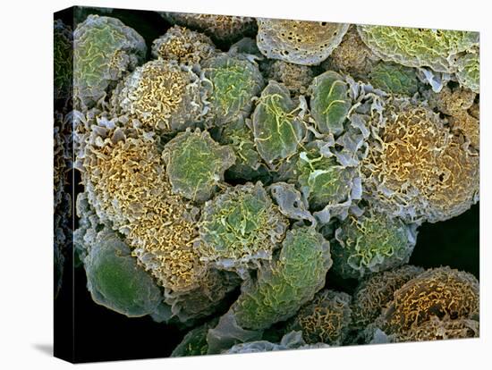 Breast Cancer Cells, SEM-Steve Gschmeissner-Premier Image Canvas