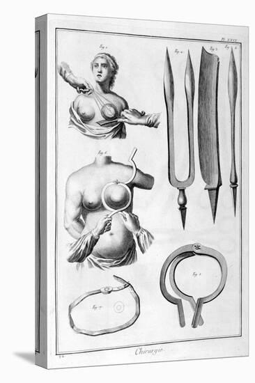 Breast Surgery, 1751-1777-Denis Diderot-Premier Image Canvas