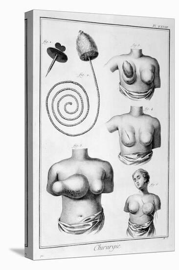 Breast Surgery, 1751-1777-Denis Diderot-Premier Image Canvas