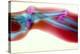 Broken Arm And Dislocated Wrist-Du Cane Medical-Premier Image Canvas