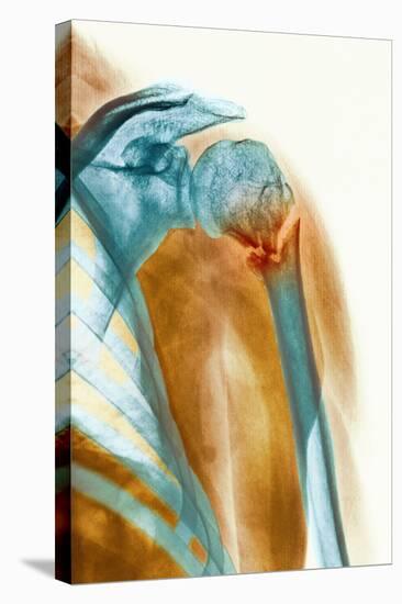 Broken Upper Arm Bone, X-ray-Science Photo Library-Premier Image Canvas