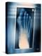 Bunion, X-ray-Miriam Maslo-Premier Image Canvas