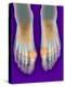Bunions, X-ray-Science Photo Library-Premier Image Canvas