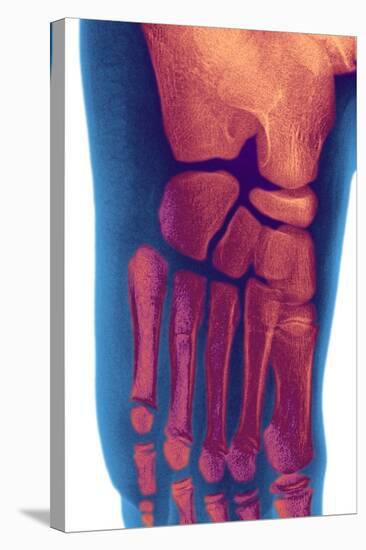 Child's Foot, X-ray-Du Cane Medical-Premier Image Canvas