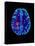 Col. MRI Scan of a Brain with Multiple Sclerosis-Science Photo Library-Premier Image Canvas