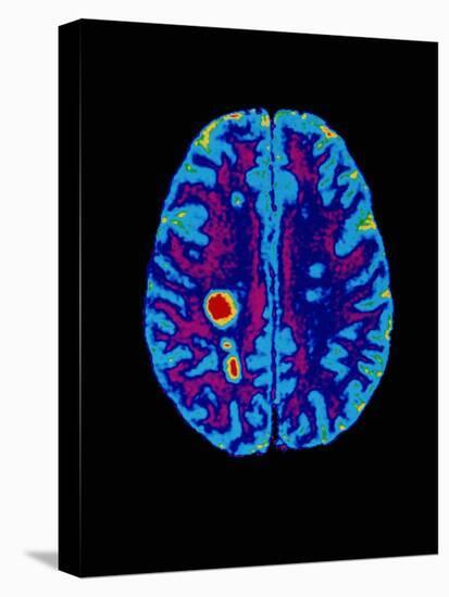 Col. MRI Scan of a Brain with Multiple Sclerosis-Science Photo Library-Premier Image Canvas