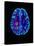 Col. MRI Scan of a Brain with Multiple Sclerosis-Science Photo Library-Premier Image Canvas