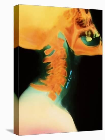 Col X-ray of Object Safety Pin Lodged In-Science Photo Library-Premier Image Canvas