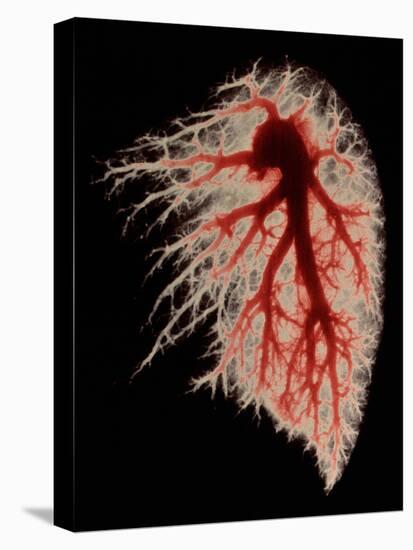 Coloured Angiogram of Pulmonary Arteries of Lung-Science Photo Library-Premier Image Canvas