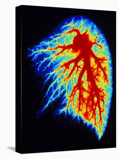 Coloured Angiogram of Pulmonary Arteries of Lung-Science Photo Library-Premier Image Canvas