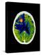 Coloured CT Scan of Brain Abscess In AIDS Patient-Science Photo Library-Premier Image Canvas