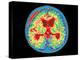 Coloured MRI Brain Scan of Abscess In Meningitis-Mehau Kulyk-Premier Image Canvas