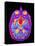 Coloured MRI Brain Scan: Pituitary Adenoma-Mehau Kulyk-Premier Image Canvas