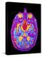 Coloured MRI Brain Scan: Pituitary Adenoma-Mehau Kulyk-Premier Image Canvas