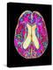 Coloured MRI Scan of Organophosphate Brain Damage-Mehau Kulyk-Premier Image Canvas