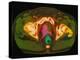 Coloured MRI Scan Showing Prostate Cancer-Science Photo Library-Premier Image Canvas