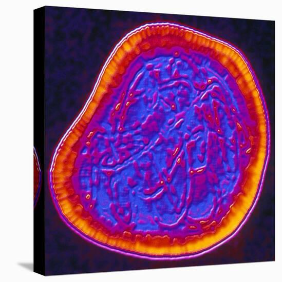 Coloured TEM of a Rubella (German Measles) Virus-PASIEKA-Premier Image Canvas