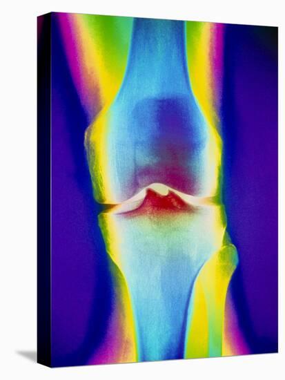 Coloured X-ray of a Human Knee Joint-Mehau Kulyk-Premier Image Canvas