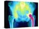 Coloured X-ray of An Artificial Hip Joint-Mehau Kulyk-Premier Image Canvas
