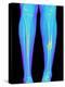 Coloured X-ray of Fractured Shin Bone (tibia)-Mehau Kulyk-Premier Image Canvas