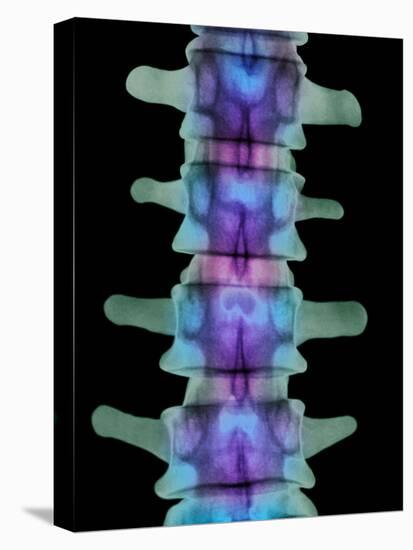 Coloured X-ray of Lumbar Vertebrae of the Spine-Science Photo Library-Premier Image Canvas