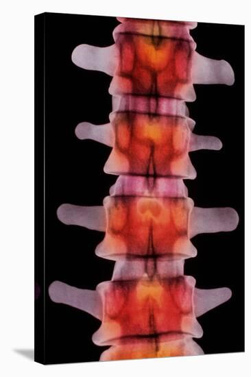 Coloured X-ray of Lumbar Vertebrae of The-Science Photo Library-Premier Image Canvas