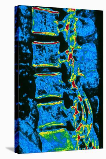 Coloured X-ray of Vertebrae with Osteoporosis-PASIEKA-Premier Image Canvas