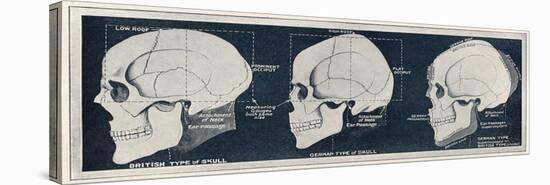 Comparison of British and German Skull Shapes, WW1-null-Stretched Canvas