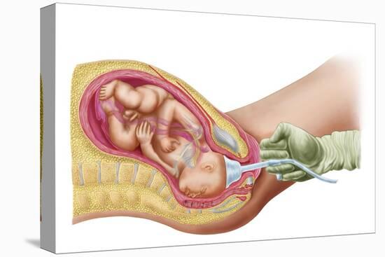 Delivery of Fetus Using Vacuum Extraction Due to Shoulder Dystocia-null-Stretched Canvas