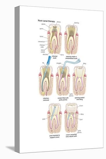 Dental Implant. Dentistry, Endodontics, Teeth, Tooth Damage, Oral Health, Health and Disease-Encyclopaedia Britannica-Stretched Canvas