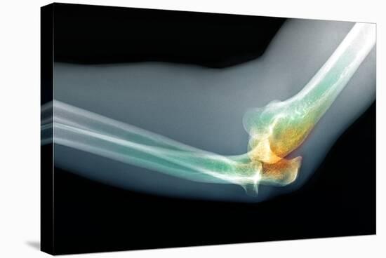 Dislocated Elbow, X-ray-Du Cane Medical-Premier Image Canvas